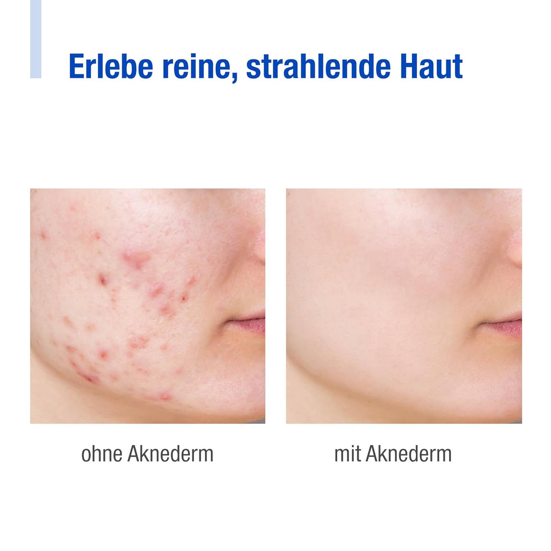 Aknederm Premium Set intens für normale Haut - Set mit Tinktur/Reinigungsschaum/Lotion/Creme intens